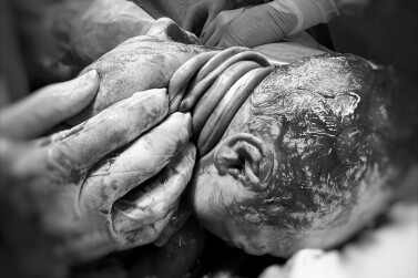Рязанские акушеры помогли родиться малышу с четырёхкратным обвитием пуповины вокруг шеи